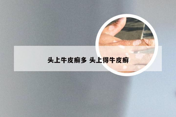 头上牛皮癣多 头上得牛皮癣