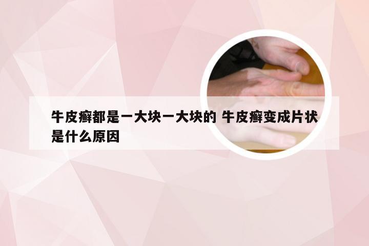 牛皮癣都是一大块一大块的 牛皮癣变成片状是什么原因