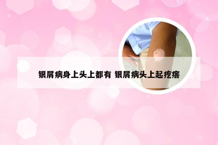 银屑病身上头上都有 银屑病头上起疙瘩