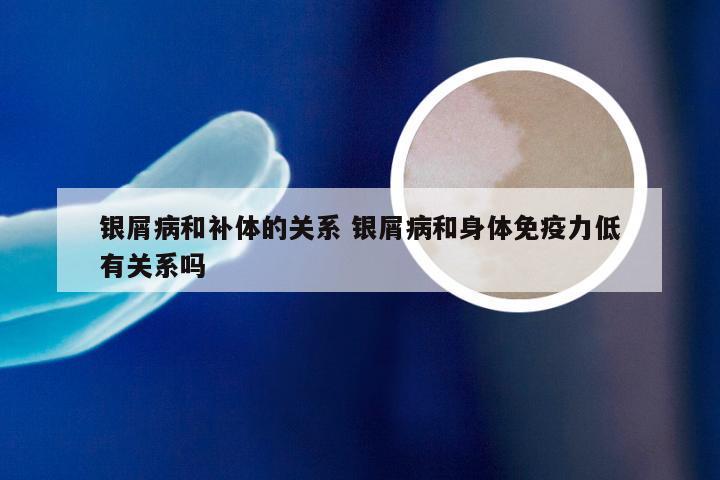 银屑病和补体的关系 银屑病和身体免疫力低有关系吗