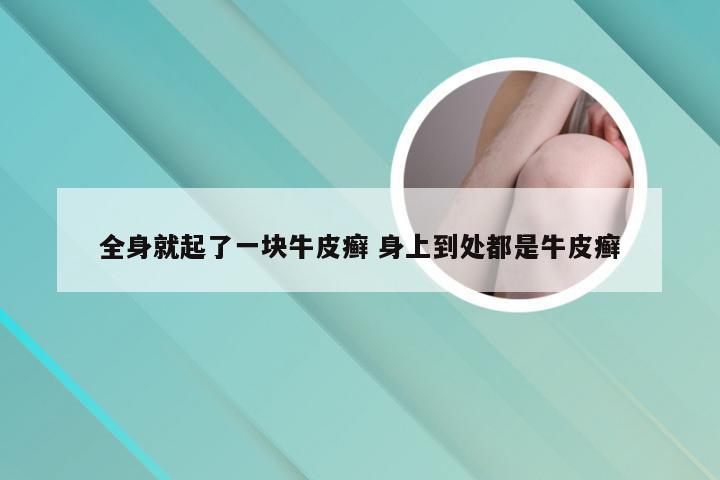 全身就起了一块牛皮癣 身上到处都是牛皮癣