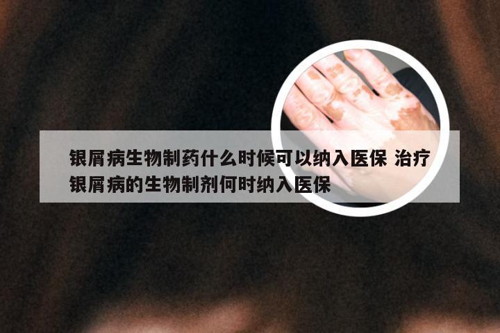银屑病生物制药什么时候可以纳入医保 治疗银屑病的生物制剂何时纳入医保