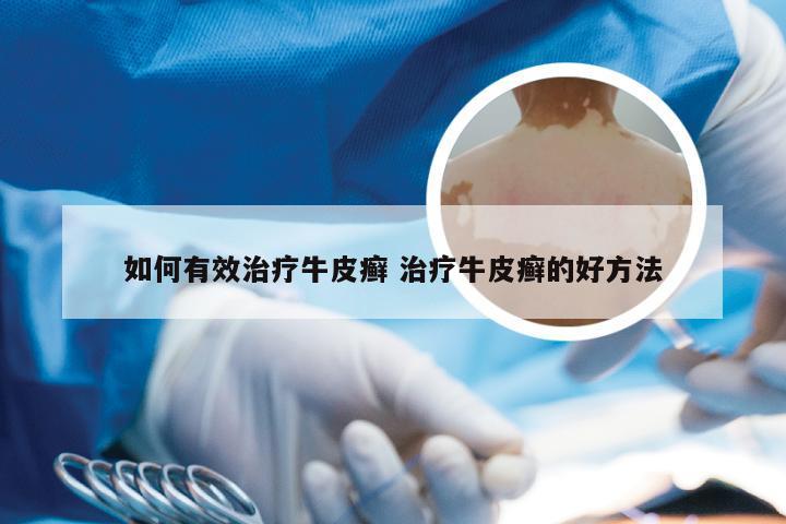 如何有效治疗牛皮癣 治疗牛皮癣的好方法