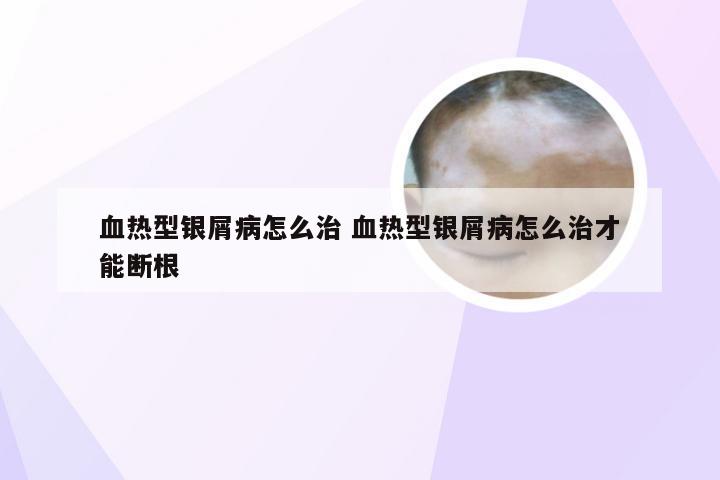血热型银屑病怎么治 血热型银屑病怎么治才能断根