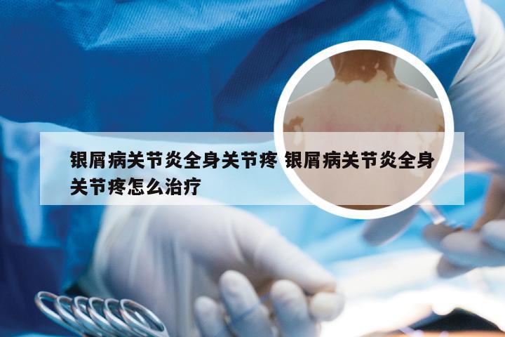 银屑病关节炎全身关节疼 银屑病关节炎全身关节疼怎么治疗