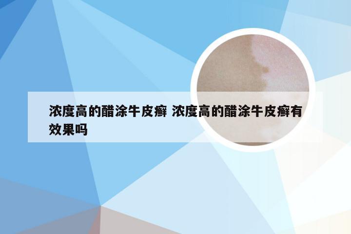浓度高的醋涂牛皮癣 浓度高的醋涂牛皮癣有效果吗