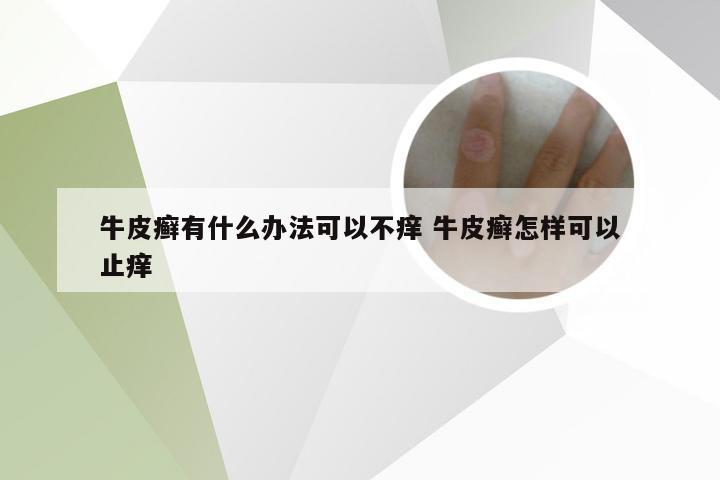 牛皮癣有什么办法可以不痒 牛皮癣怎样可以止痒