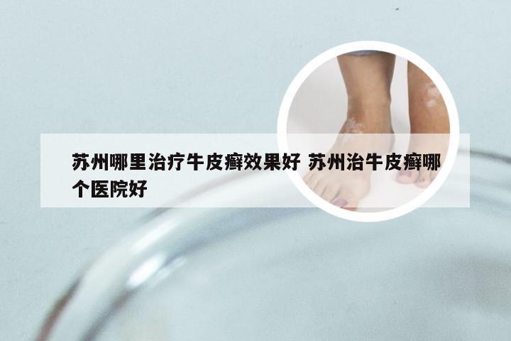 苏州哪里治疗牛皮癣效果好 苏州治牛皮癣哪个医院好