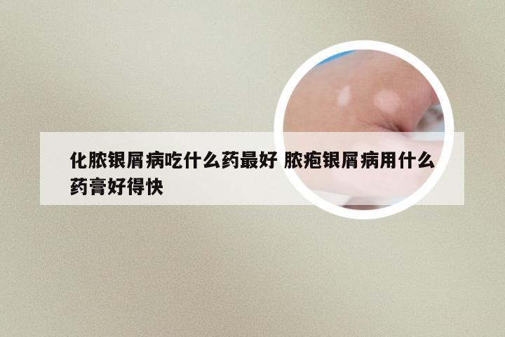 化脓银屑病吃什么药最好 脓疱银屑病用什么药膏好得快