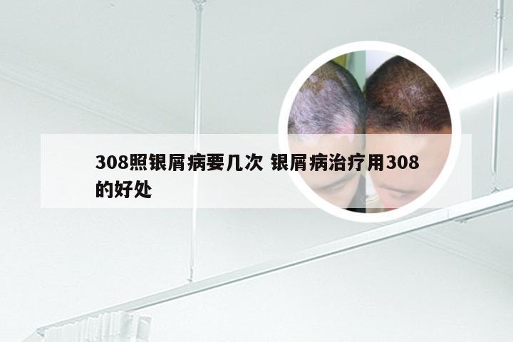 308照银屑病要几次 银屑病治疗用308的好处