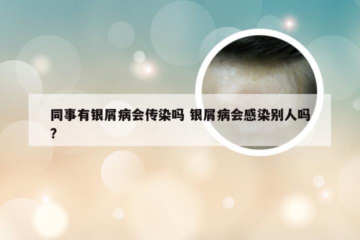 同事有银屑病会传染吗 银屑病会感染别人吗?