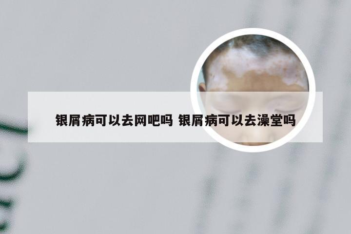 银屑病可以去网吧吗 银屑病可以去澡堂吗