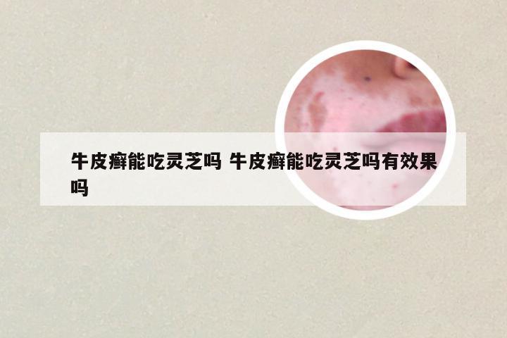 牛皮癣能吃灵芝吗 牛皮癣能吃灵芝吗有效果吗