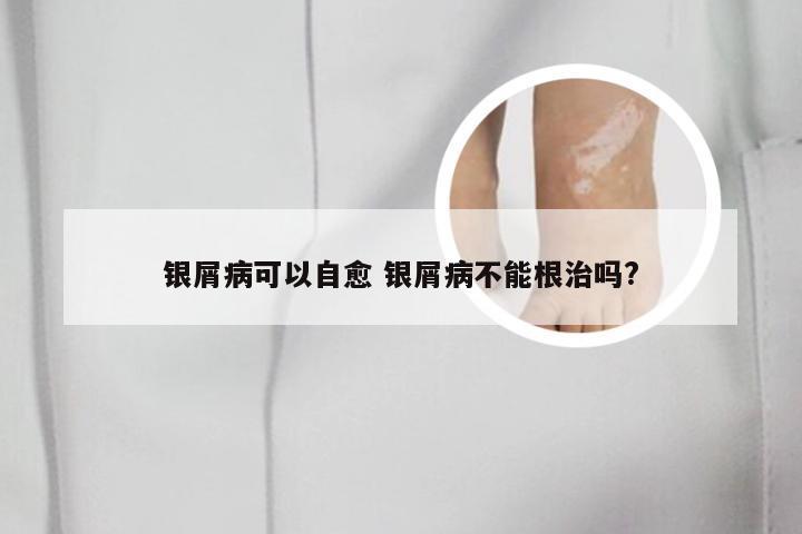 银屑病可以自愈 银屑病不能根治吗?