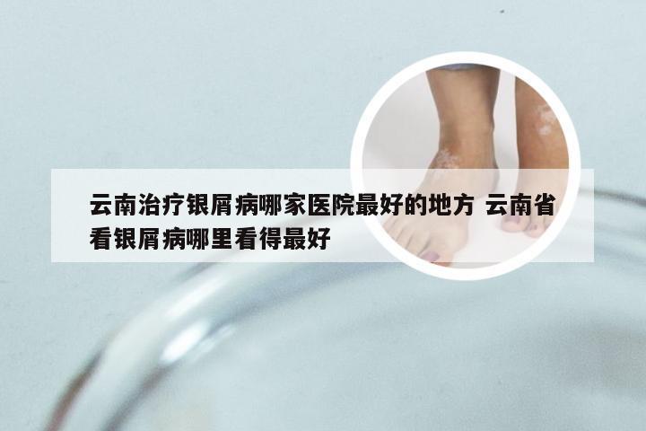 云南治疗银屑病哪家医院最好的地方 云南省看银屑病哪里看得最好