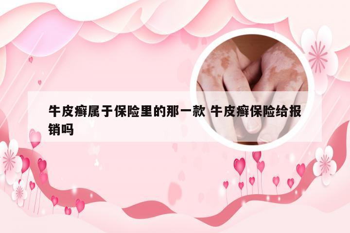 牛皮癣属于保险里的那一款 牛皮癣保险给报销吗