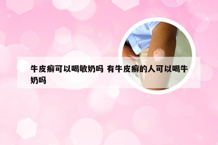 牛皮癣可以喝敏奶吗 有牛皮癣的人可以喝牛奶吗