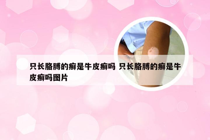 只长胳膊的癣是牛皮癣吗 只长胳膊的癣是牛皮癣吗图片