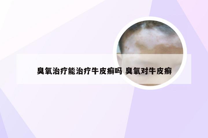 臭氧治疗能治疗牛皮癣吗 臭氧对牛皮癣