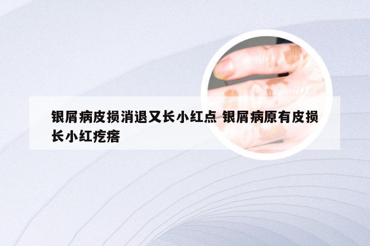 银屑病皮损消退又长小红点 银屑病原有皮损长小红疙瘩