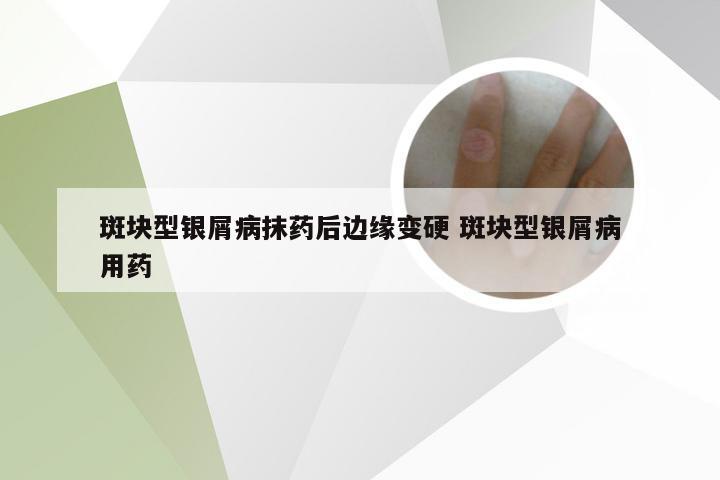 斑块型银屑病抹药后边缘变硬 斑块型银屑病用药