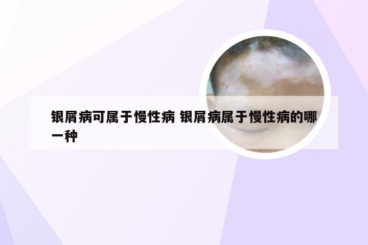 银屑病可属于慢性病 银屑病属于慢性病的哪一种