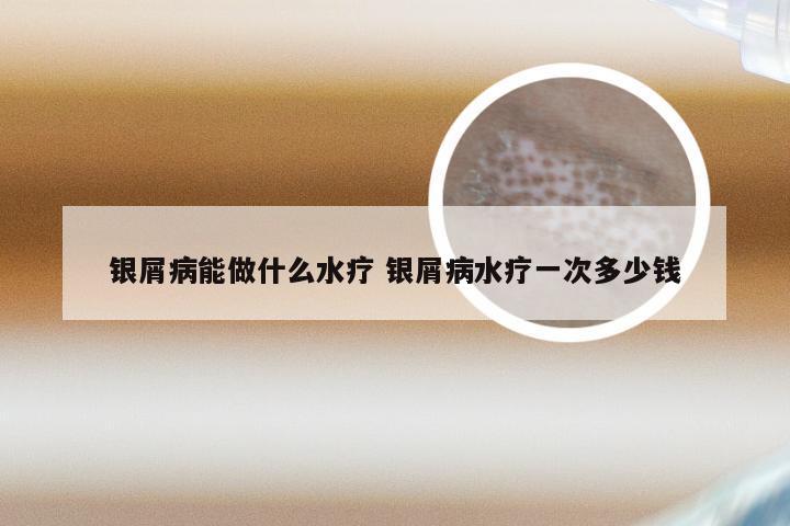 银屑病能做什么水疗 银屑病水疗一次多少钱