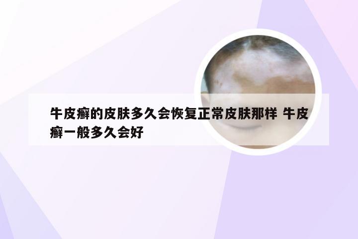 牛皮癣的皮肤多久会恢复正常皮肤那样 牛皮癣一般多久会好