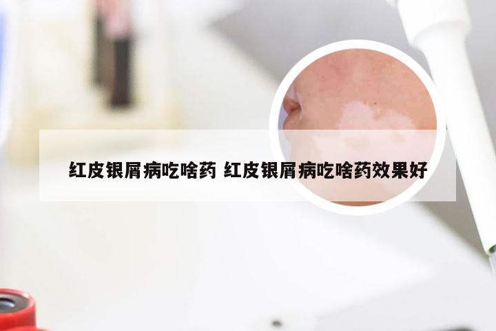 红皮银屑病吃啥药 红皮银屑病吃啥药效果好