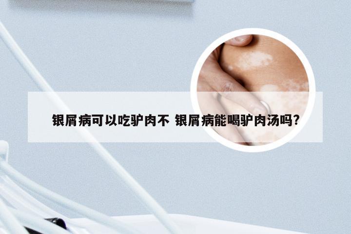 银屑病可以吃驴肉不 银屑病能喝驴肉汤吗?