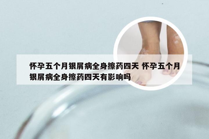 怀孕五个月银屑病全身擦药四天 怀孕五个月银屑病全身擦药四天有影响吗