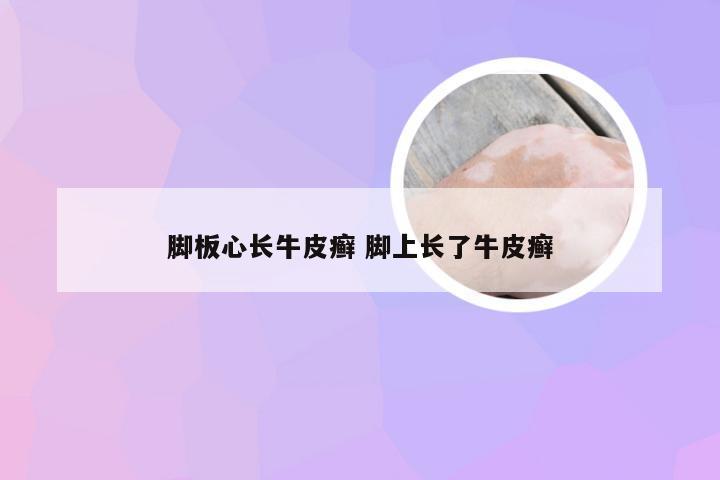 脚板心长牛皮癣 脚上长了牛皮癣