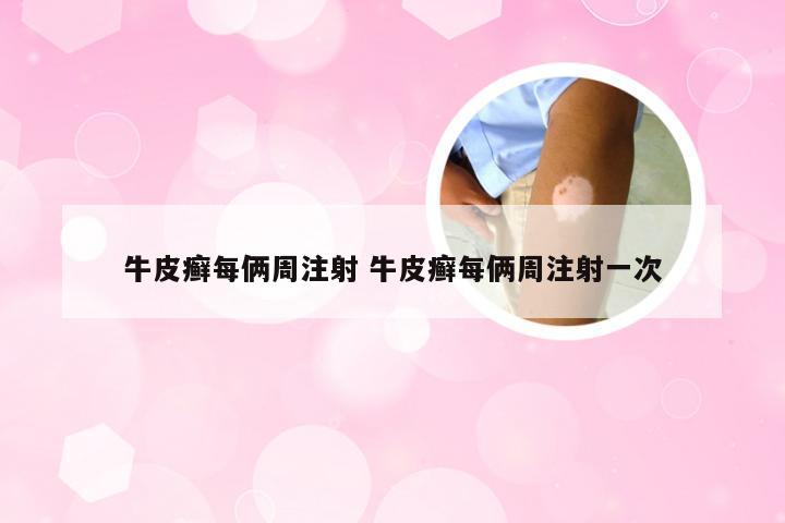 牛皮癣每俩周注射 牛皮癣每俩周注射一次