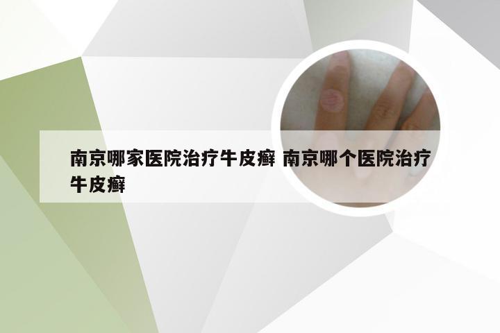 南京哪家医院治疗牛皮癣 南京哪个医院治疗牛皮癣