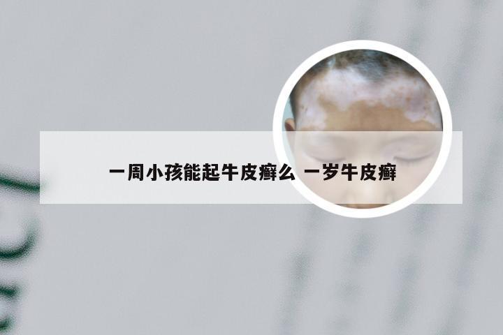 一周小孩能起牛皮癣么 一岁牛皮癣