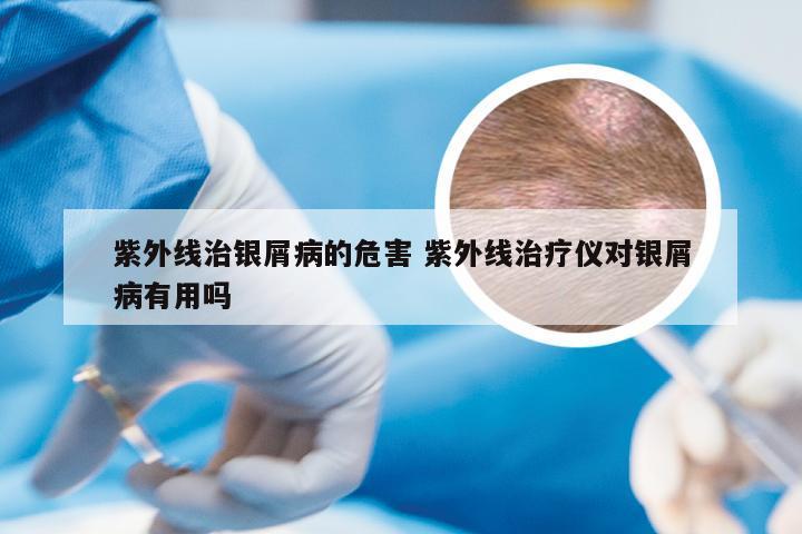 紫外线治银屑病的危害 紫外线治疗仪对银屑病有用吗