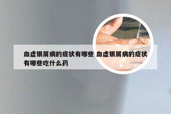 血虚银屑病的症状有哪些 血虚银屑病的症状有哪些吃什么药