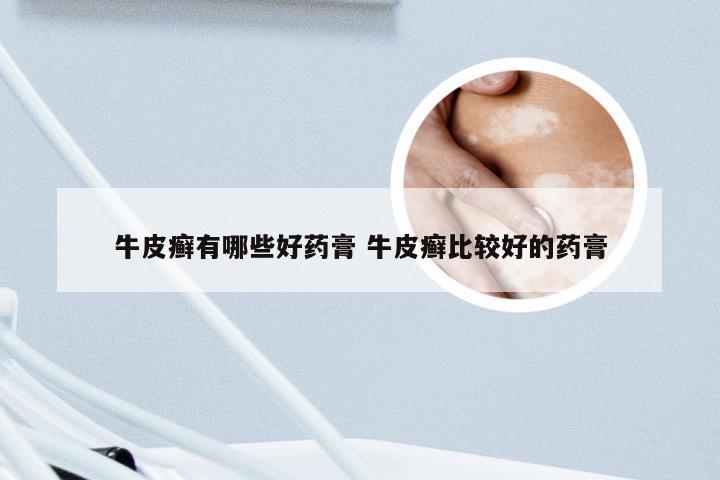 牛皮癣有哪些好药膏 牛皮癣比较好的药膏