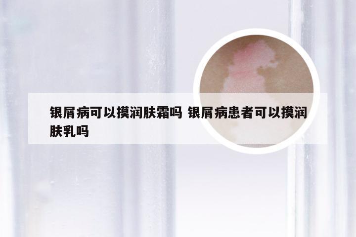银屑病可以摸润肤霜吗 银屑病患者可以摸润肤乳吗