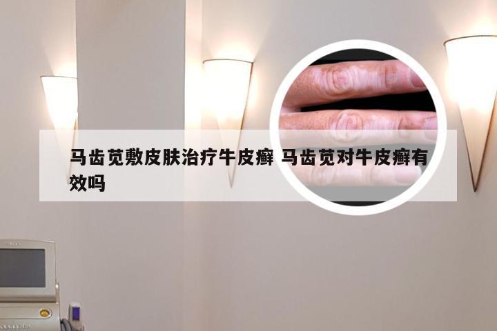 马齿苋敷皮肤治疗牛皮癣 马齿苋对牛皮癣有效吗