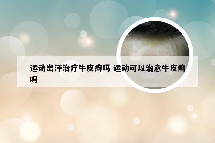 运动出汗治疗牛皮癣吗 运动可以治愈牛皮癣吗