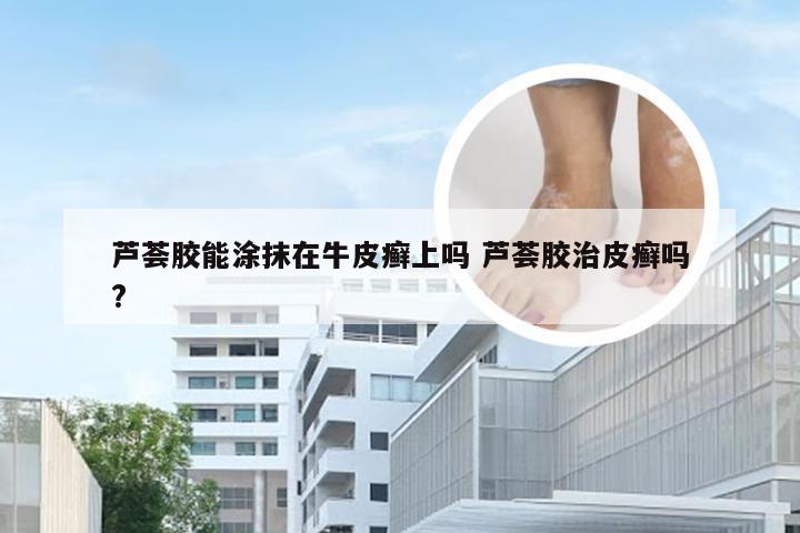 芦荟胶能涂抹在牛皮癣上吗 芦荟胶治皮癣吗?