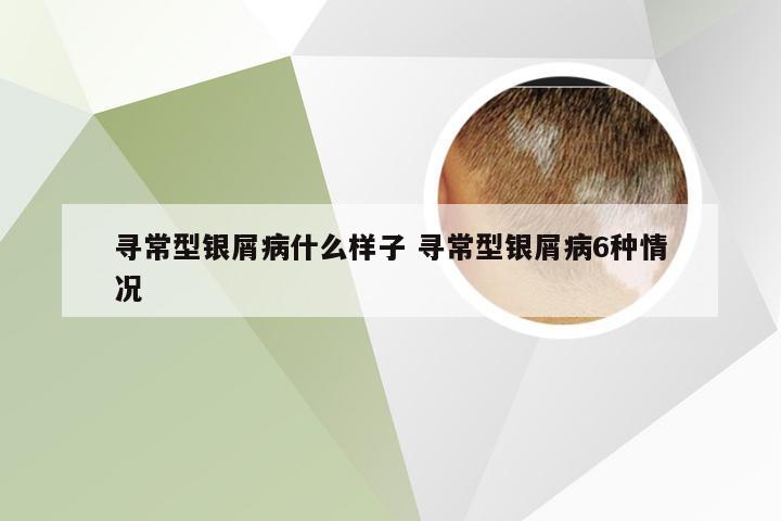 寻常型银屑病什么样子 寻常型银屑病6种情况