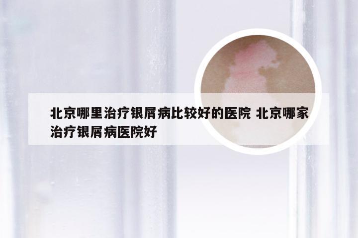 北京哪里治疗银屑病比较好的医院 北京哪家治疗银屑病医院好