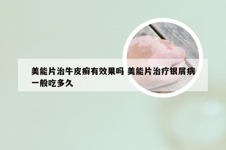 美能片治牛皮癣有效果吗 美能片治疗银屑病一般吃多久