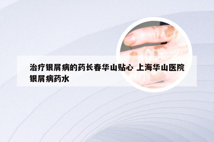 治疗银屑病的药长春华山贴心 上海华山医院银屑病药水
