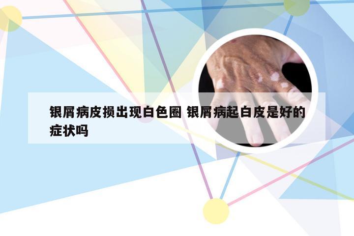 银屑病皮损出现白色圈 银屑病起白皮是好的症状吗