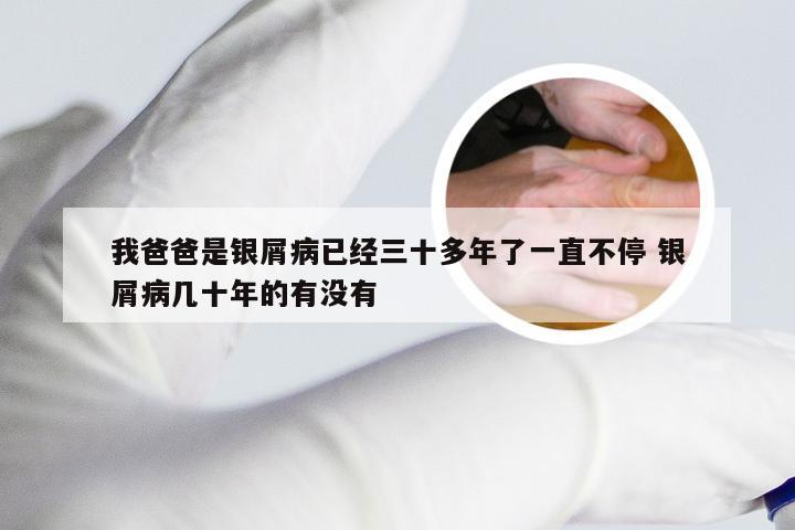 我爸爸是银屑病已经三十多年了一直不停 银屑病几十年的有没有