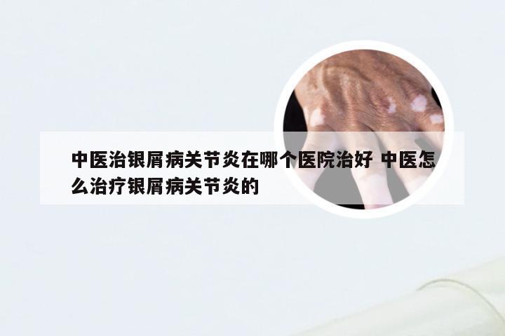 中医治银屑病关节炎在哪个医院治好 中医怎么治疗银屑病关节炎的