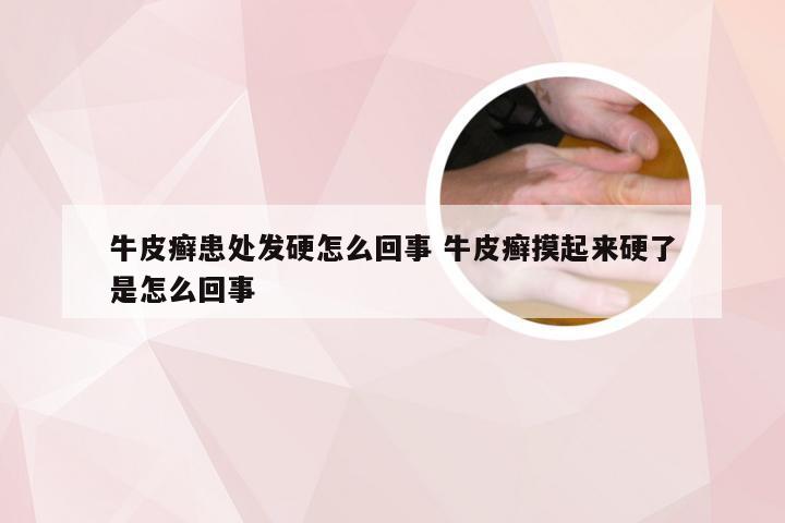 牛皮癣患处发硬怎么回事 牛皮癣摸起来硬了是怎么回事